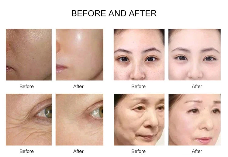 Needle Free Mesotherapy Machine 5G MNCM Micro Nano Chip Meso Gun EMS RF + MESO - Image 11