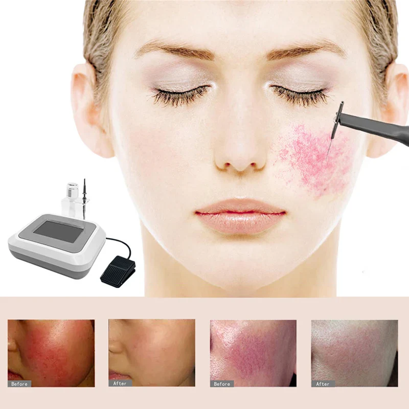NEW Red Blood Vessel Spots Vascular Removal Beauty Equipment Needle RF Spider Veins Remover High Frequency Anti Redness Machine - Image 3