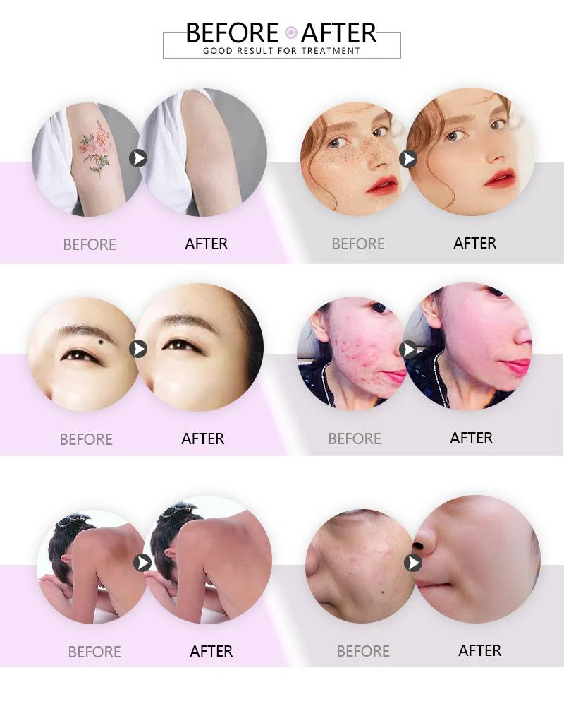 Picosecond Laser Tattoo Removal Machine 1064nm 532nm 1320nm  Spots Tattoo Removal Eyebrow Pigment Picosecond Beauty Machine - Image 5