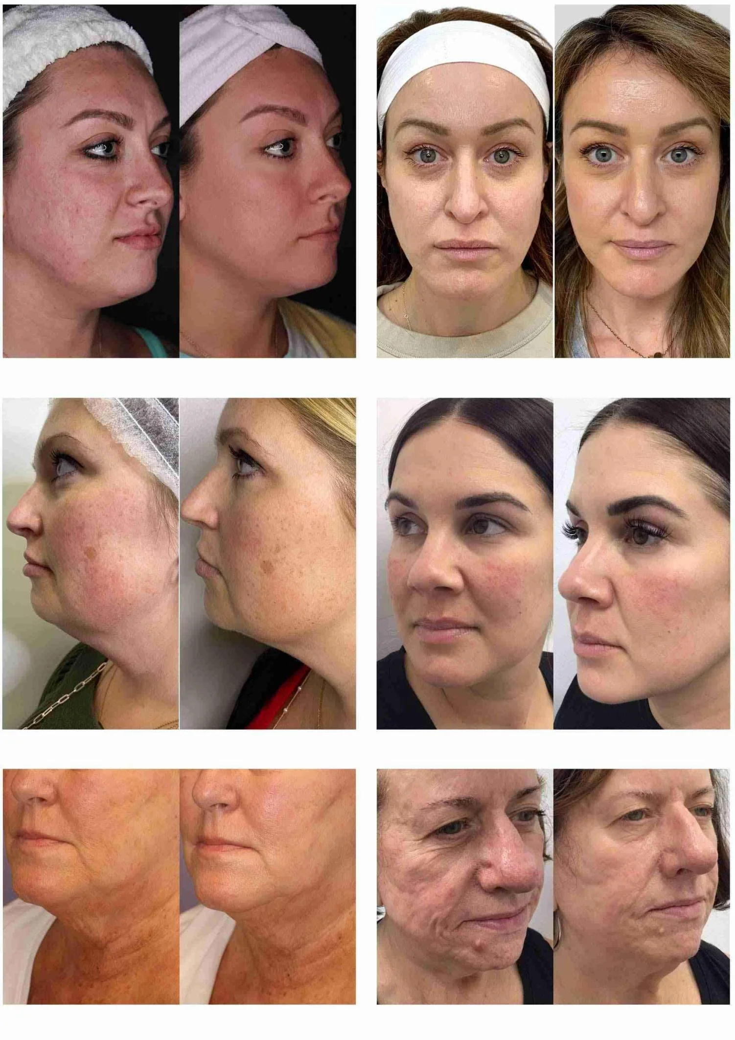 Portable 2 In 1 Morpheus8 Machine Skin Lifting Anti-aging Freckle Wrinkle Removal Acne Treatment Fractional Salon Use Device - Image 2