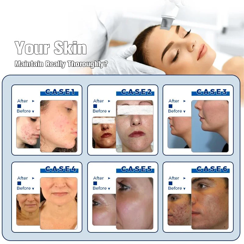 Professional Multifunctional 14in 1 Machine Beauty SPA Oxygen Water Diamond Dermabrasion Facial Cleaning - Image 6