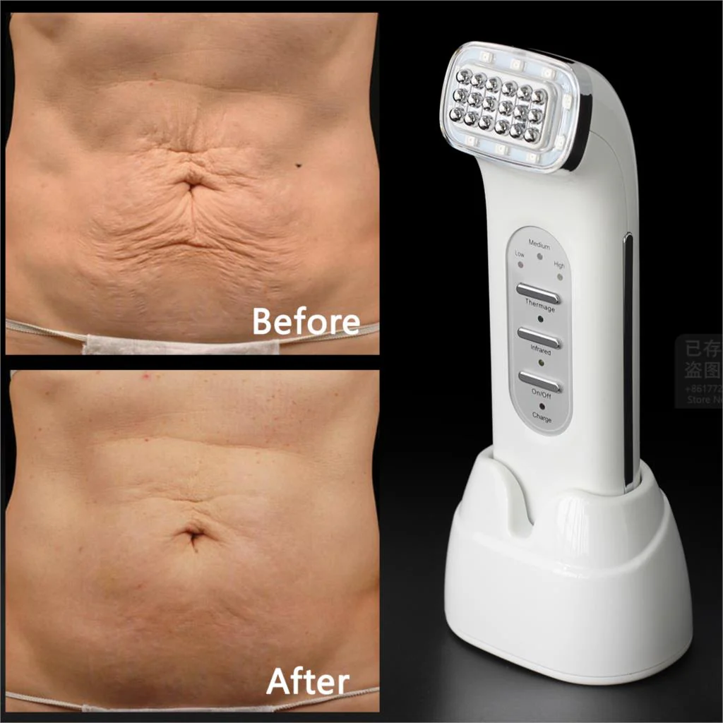 Real Remove Wrinkles Dot Matrix Facial Thermage Radio Frequency Lifting Face Lift Body SKin Care Beauty Device 110-240V - Image 2