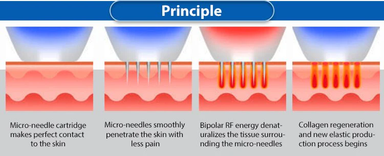 Gold MicroNeedle Machine Revolutionary RF Microneedling Machine: Transform Your Skin - Image 3