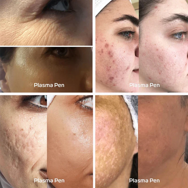 Revitalize Your Skin With Plasma Ozone Pen For Acne Treatment, Skin Rejuvenation, Scar Reduction, Skin Tightening - Image 6