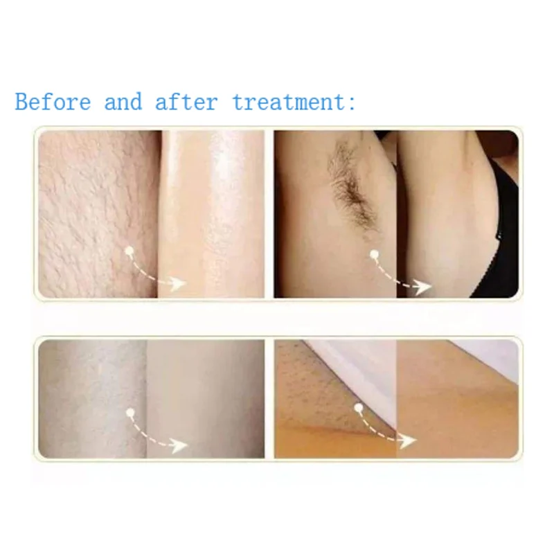 SHR Hair Removal Machine IPL OPT SHR Hair Removal Skin Care Rejuvenation With 480nm 530nm 640nm Filters - Image 7