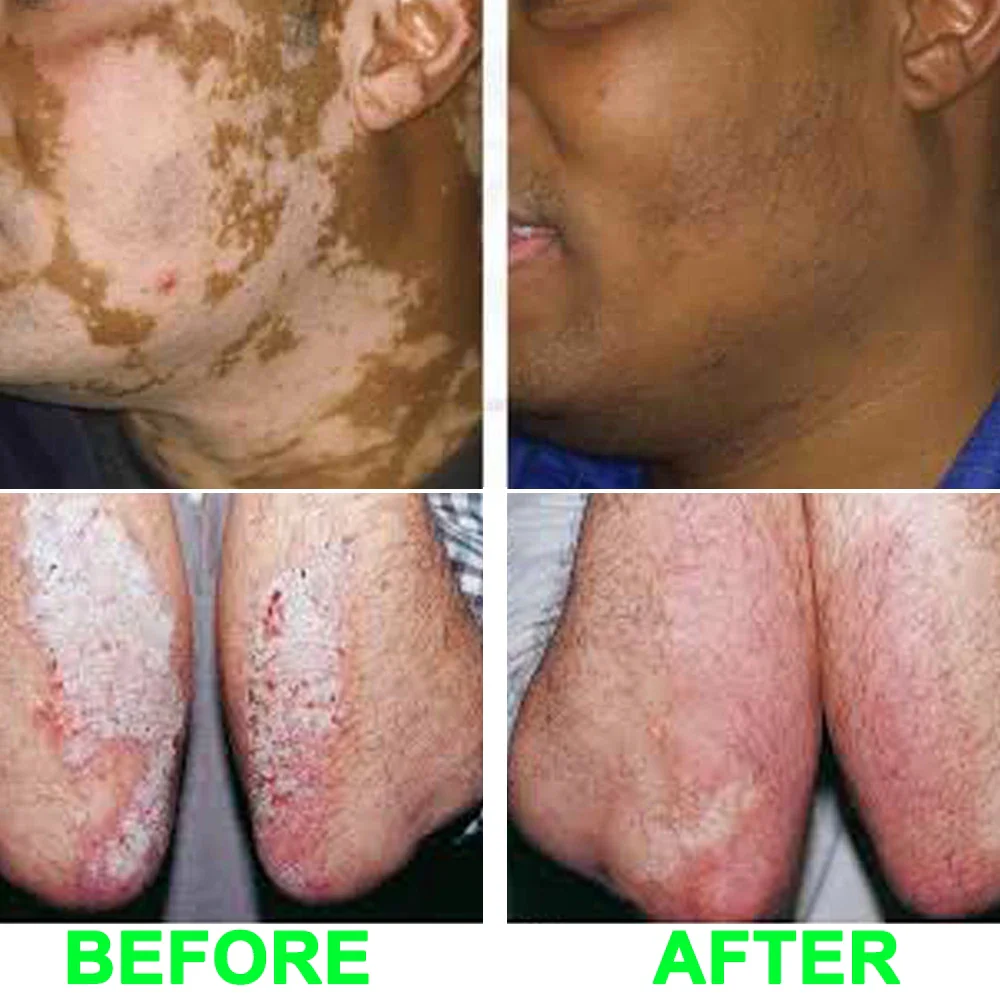 SIGMA 311nm NB UVB Phototherapy UV Lamp Psoriasis Vitiligo Treatment Eczema SH2B SH2B-J - Image 3
