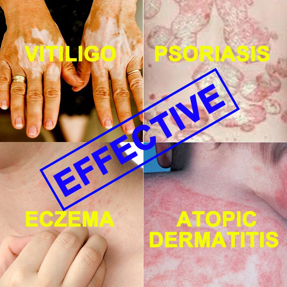 SIGMA 311nm NB UVB Phototherapy UV Lamp Psoriasis Vitiligo Treatment Eczema SH2B SH2B-J - Image 6