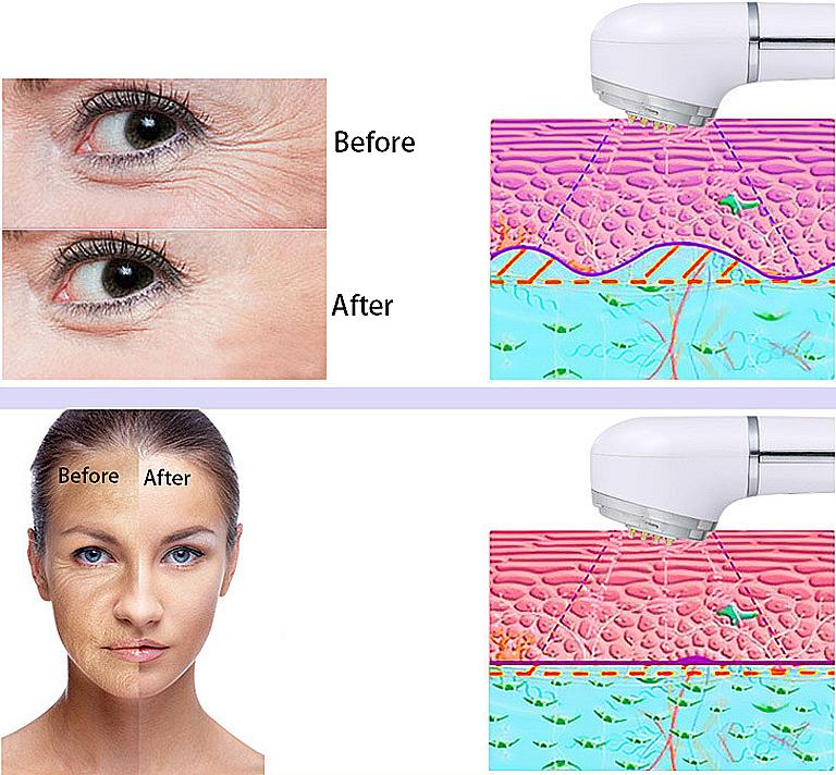 Skin Rejuvenation EMS Mesotherapy Electroporation Facial RF Radio Frequency Skin Care Tighten Lifting Massage Machine - Image 4
