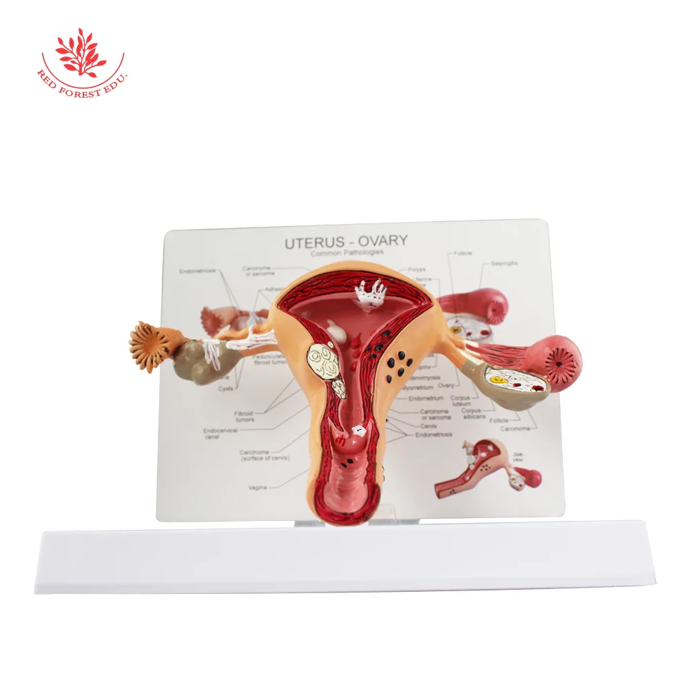 Uterus Model Female Reproductive Organs Anatomy Model Pathological for Anatomical Education from Forestedu - Image 5