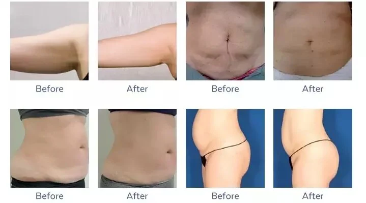 VelaShape Machine Transform Your Body with Advanced Non-Invasive Technology for Weight Loss and Fat Reduction - Image 9